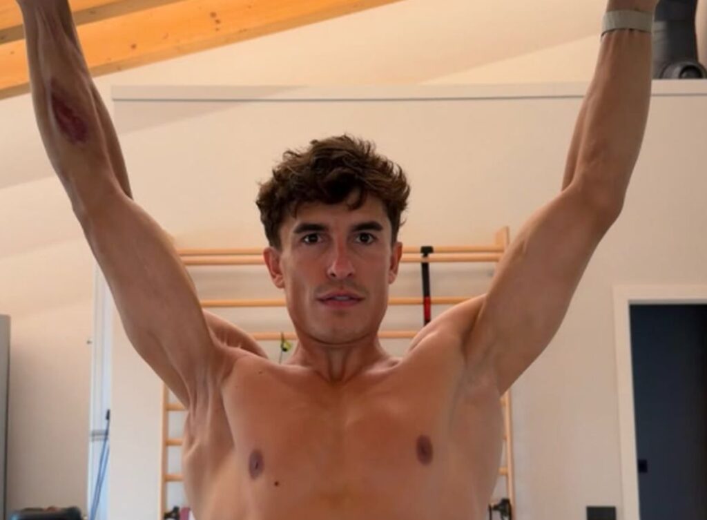 Marquez, la foto social svela il dettaglio choc, il chirurgo: “Corre con un braccio e mezzo” Marc Marquez